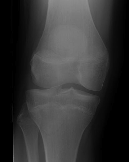 Femoral OCD